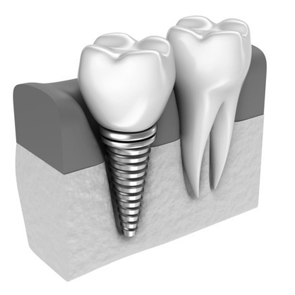 Implants